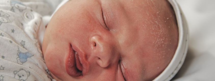 Cradle cap on the face