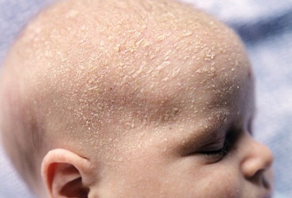 What Type of Baby Shampoo is Good For Cradle Cap - Cradle Cap