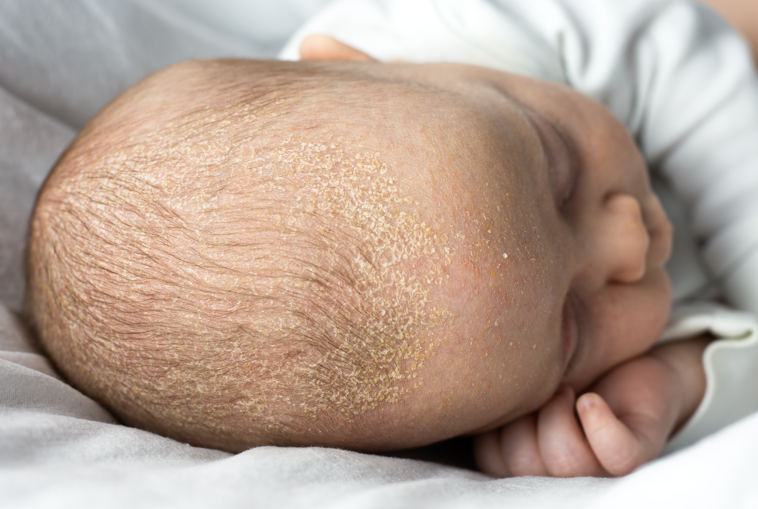 What causes cradle cap in babies?